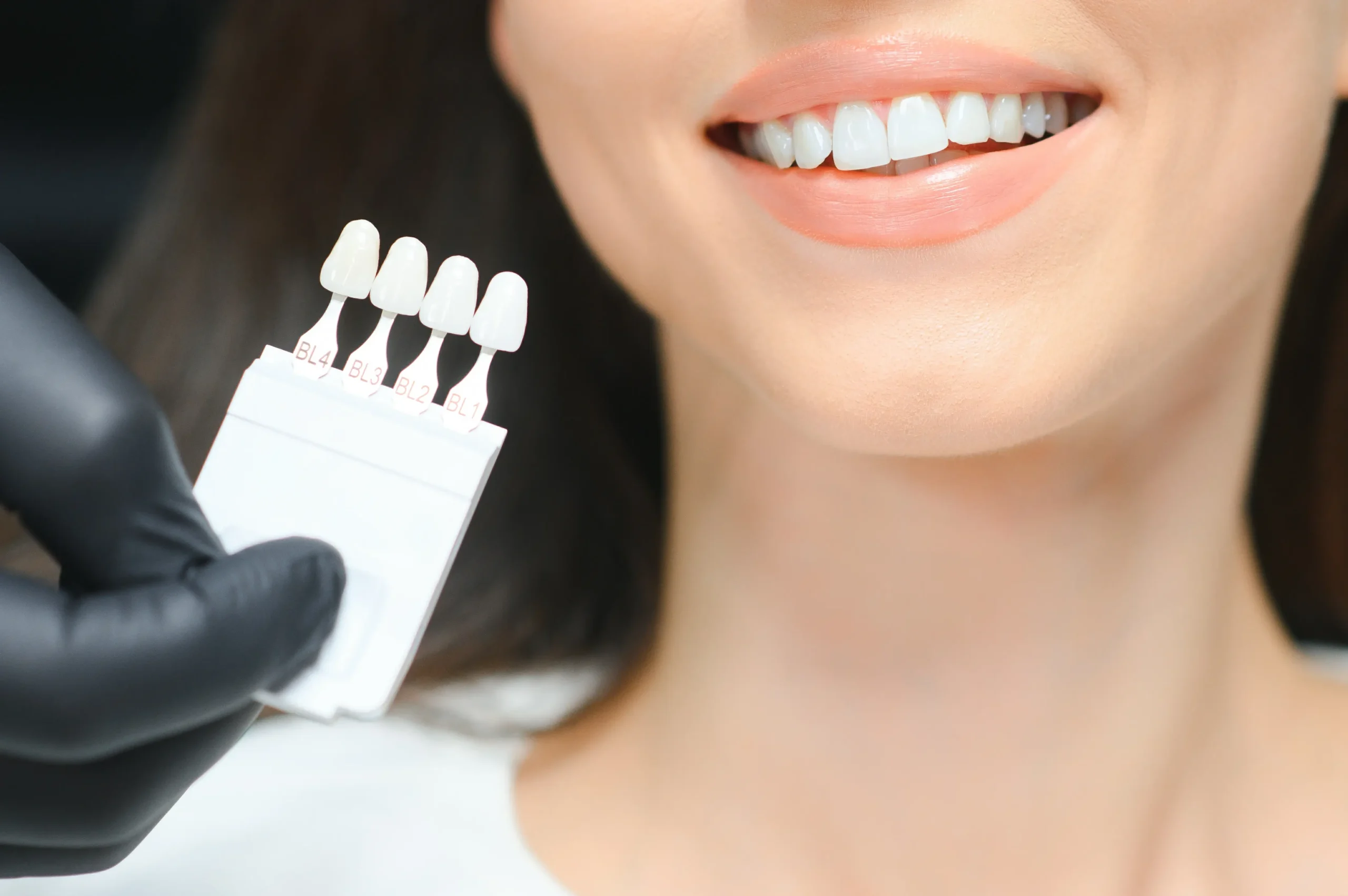 Are Veneers Worth It? What Fairfax Patients Should Know Before Deciding
